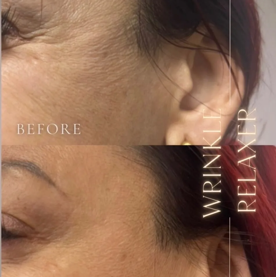 Wrinkle relaxer before and after, crow's feet, Aesthetx Haus client