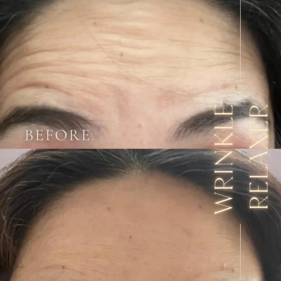 Wrinkle relaxer before and after, forehead lines, Aesthetx Haus client