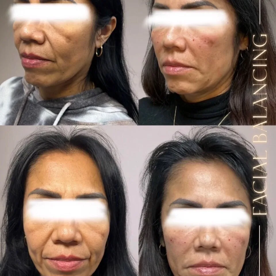 Facial balancing before and after, front and three-quarter views, Aesthetx Haus client