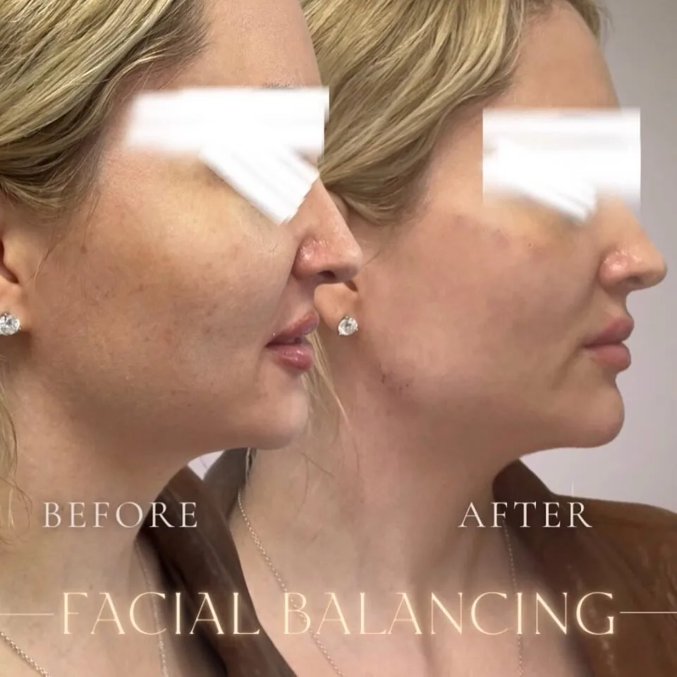 Facial balancing before and after, side profile, Aesthetx Haus client