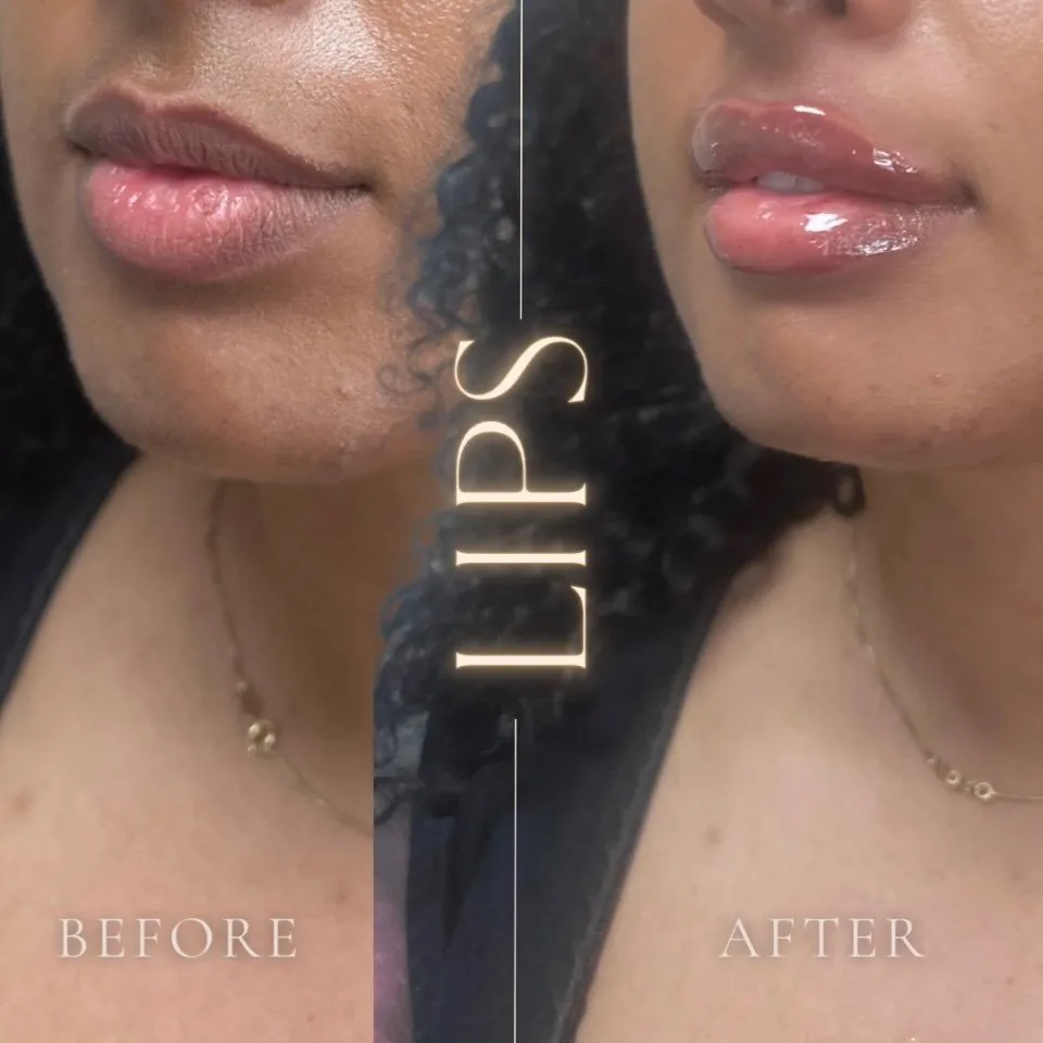 Lip filler before and after, side by side, Aesthetx Haus client