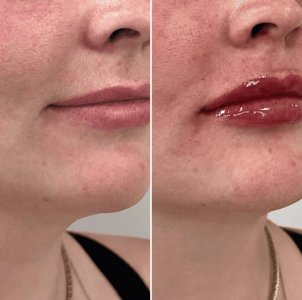 Lip filler before and after, three-quarter view, Aesthetx Haus client