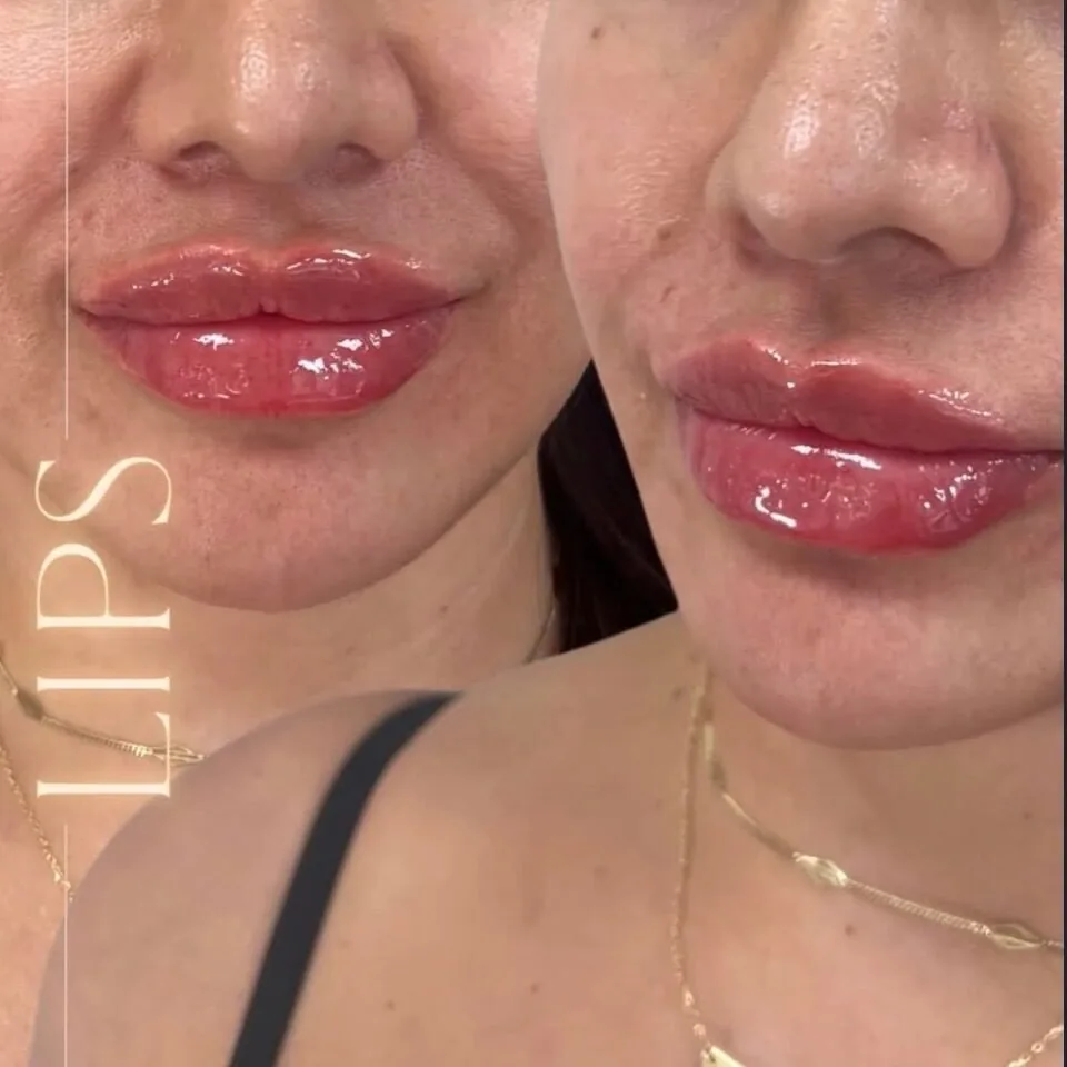 Lip filler before and after, close-up, Aesthetx Haus client