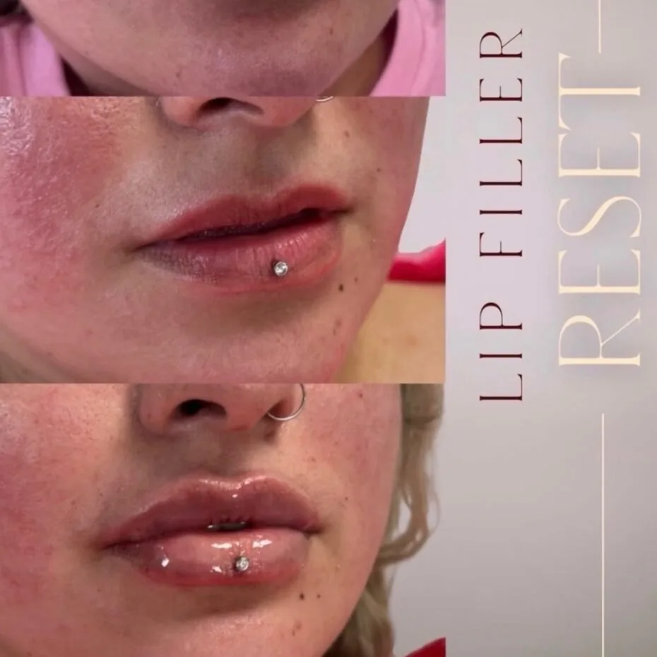 Lip filler reset before and after, migrated filler dissolved then lips refilled