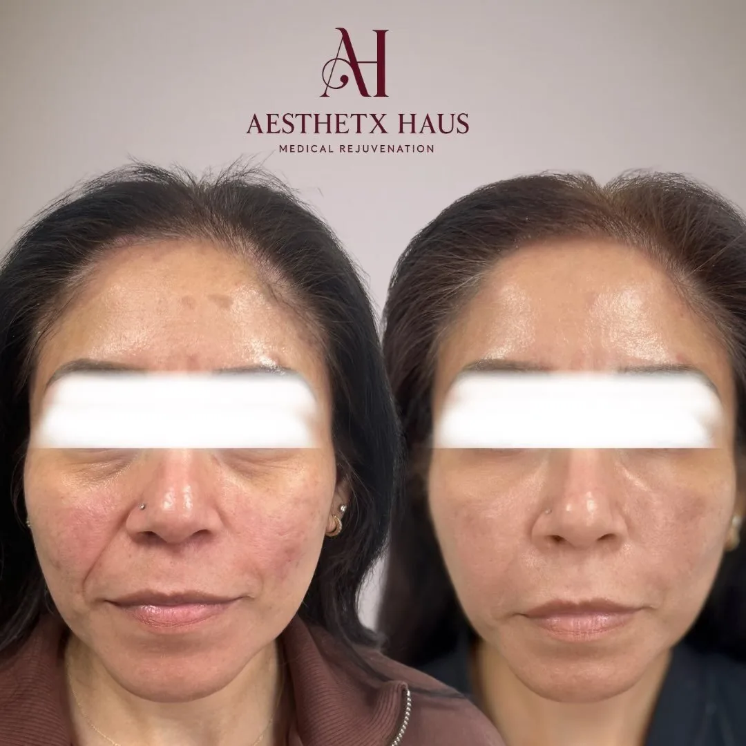 Skin treatment before and after, redness and texture, Aesthetx Haus client