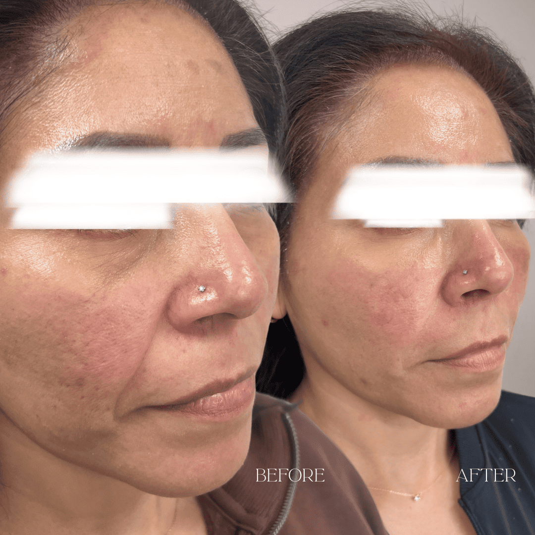 Before and after results at Aesthetx Haus, Walnut Creek