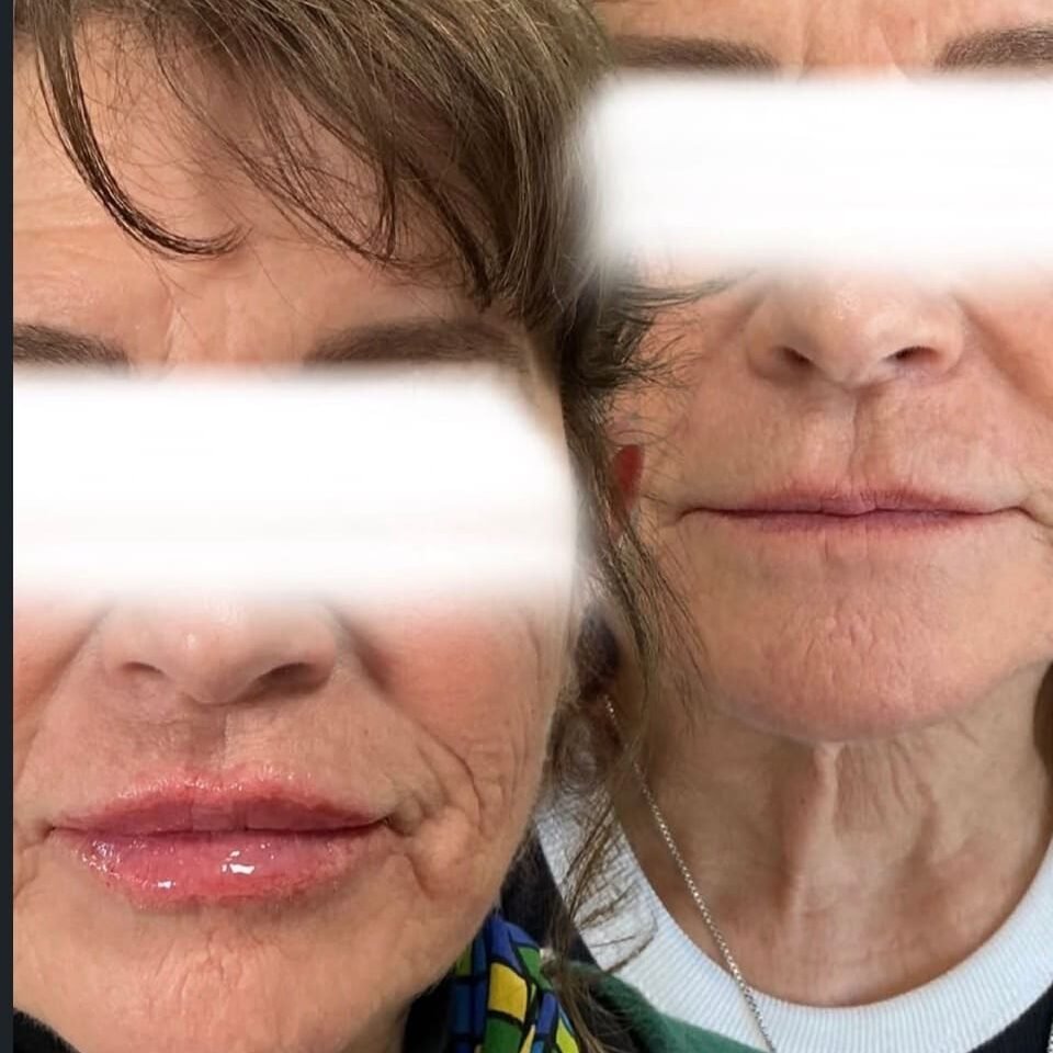 Before and after results