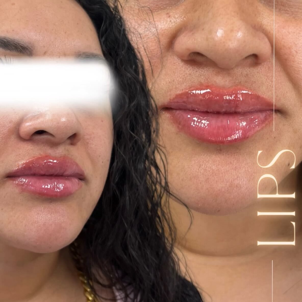 Lip filler before and after results at Aesthetx Haus