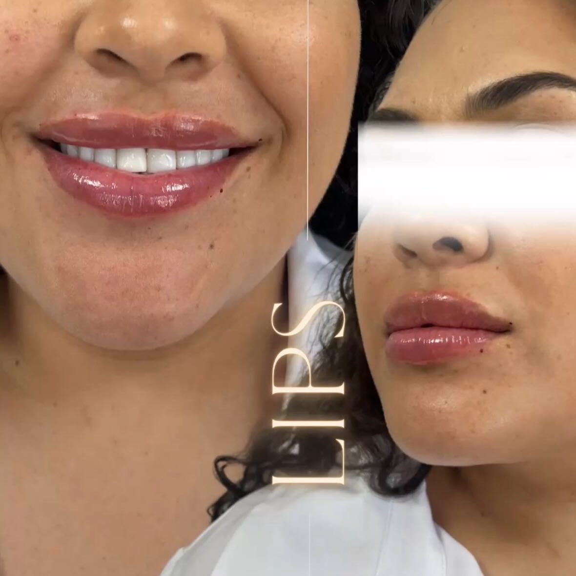 Lip filler before and after results at Aesthetx Haus
