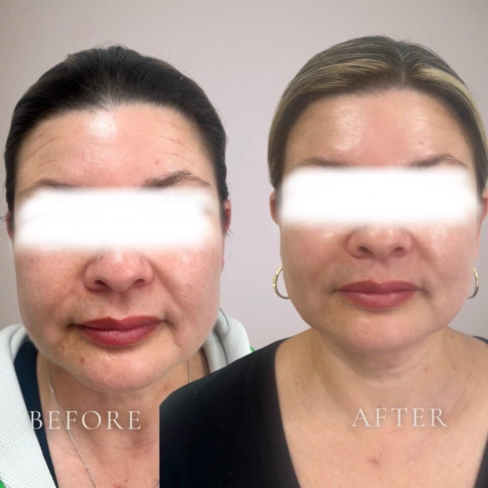 Facial balancing before and after, side profile view