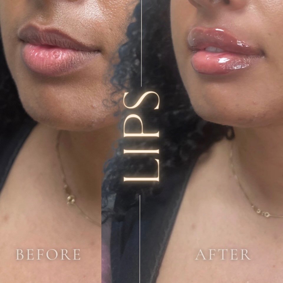 Lip filler before and after, close-up