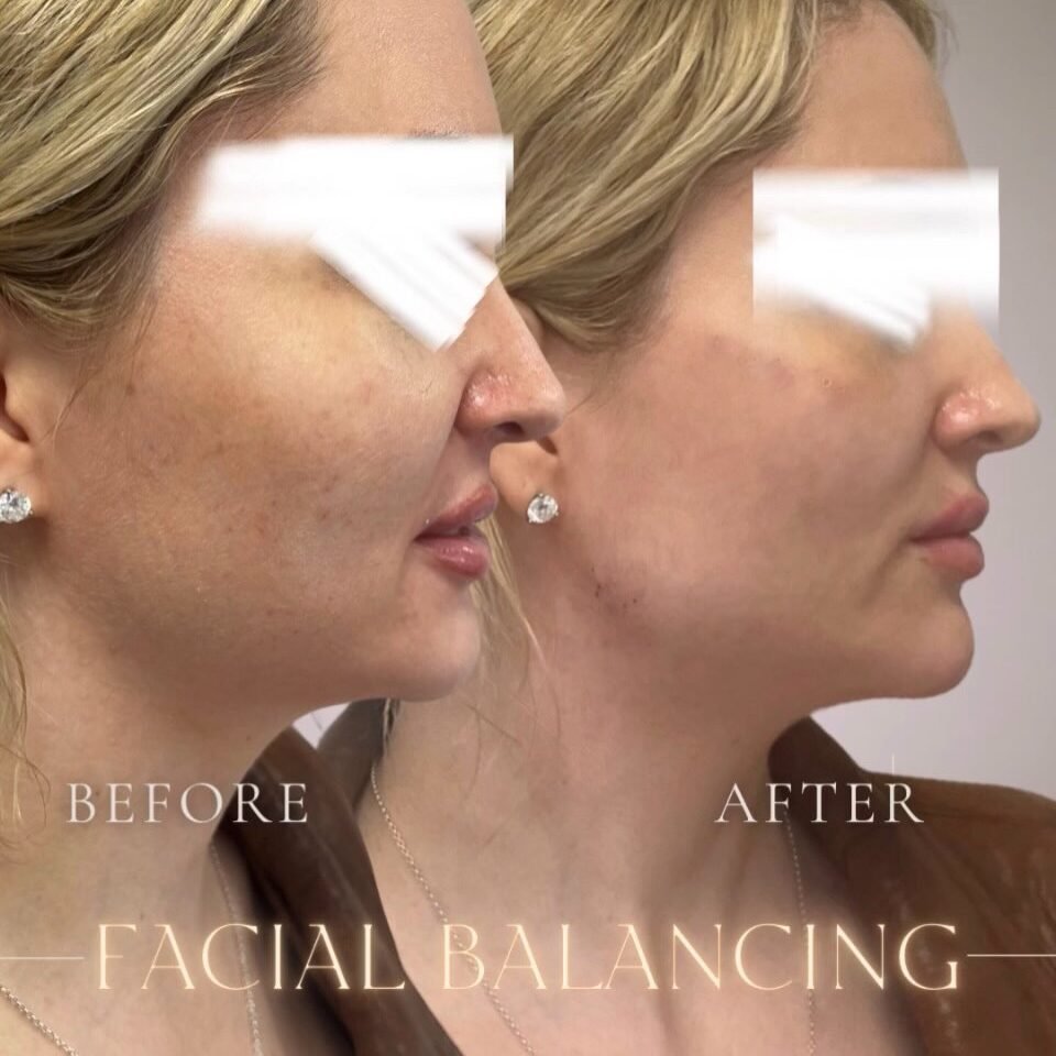Facial balancing before and after, side profile view