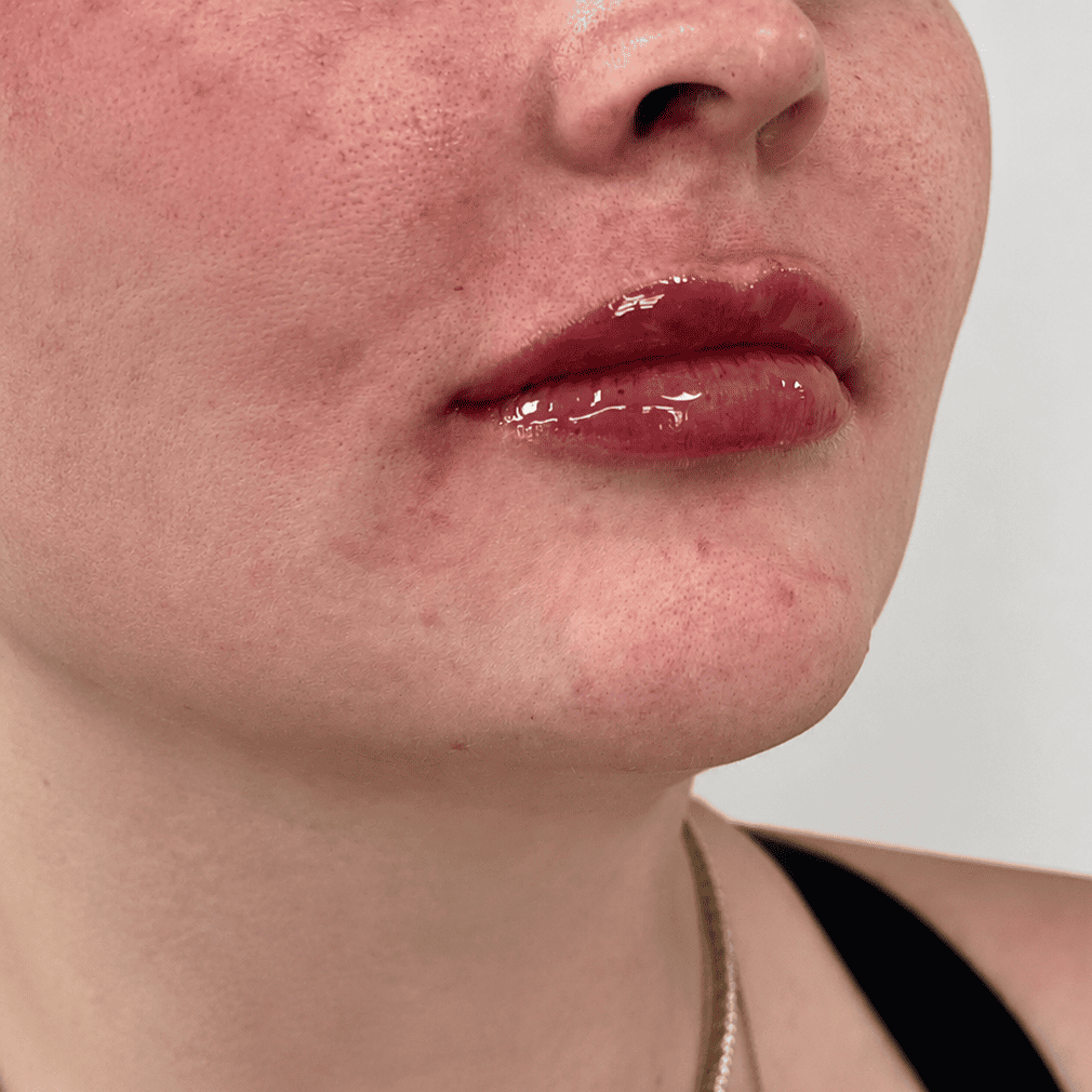 Lip filler after: the same client's lips with added volume and definition