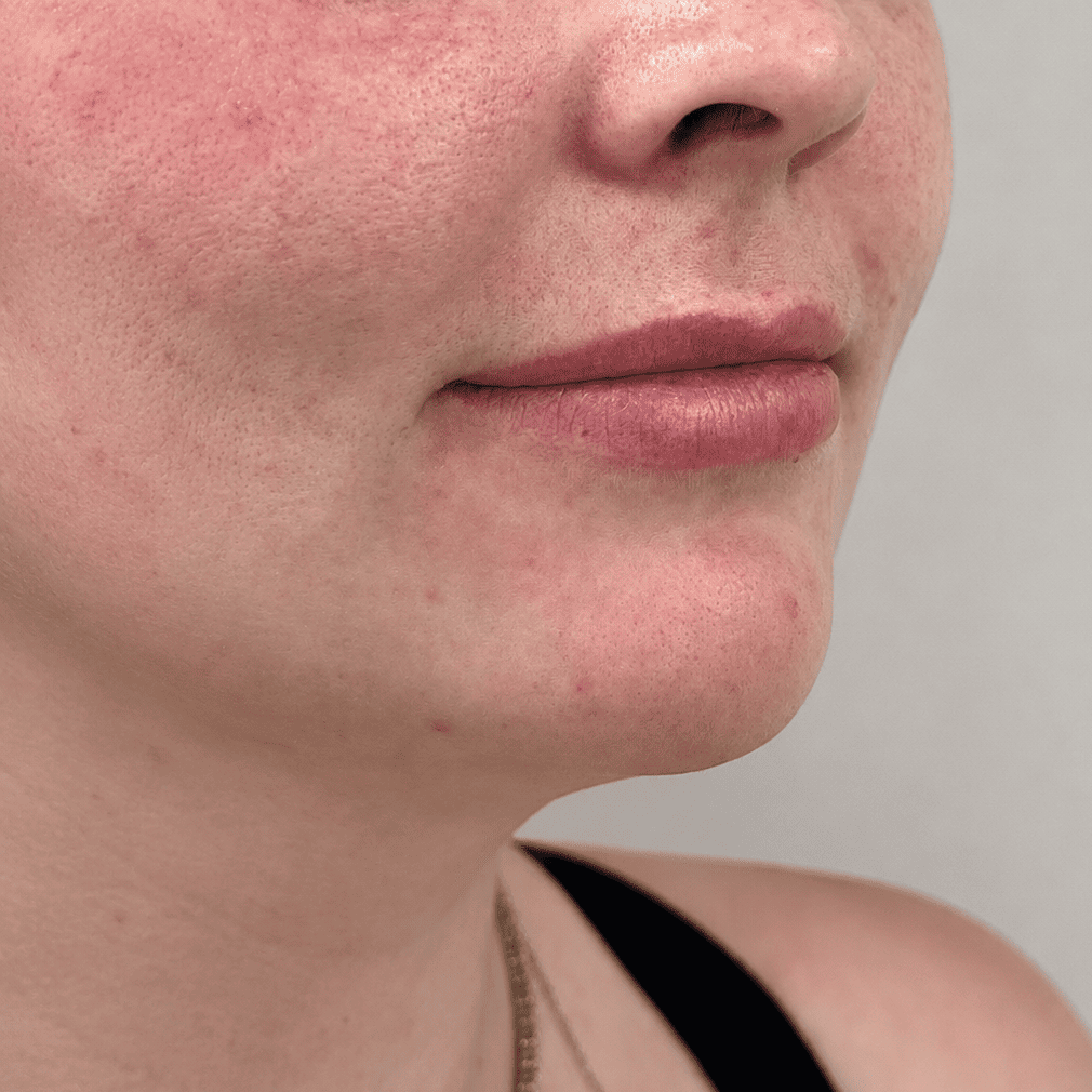 Lip filler before: close-up of a client's lips and lower face